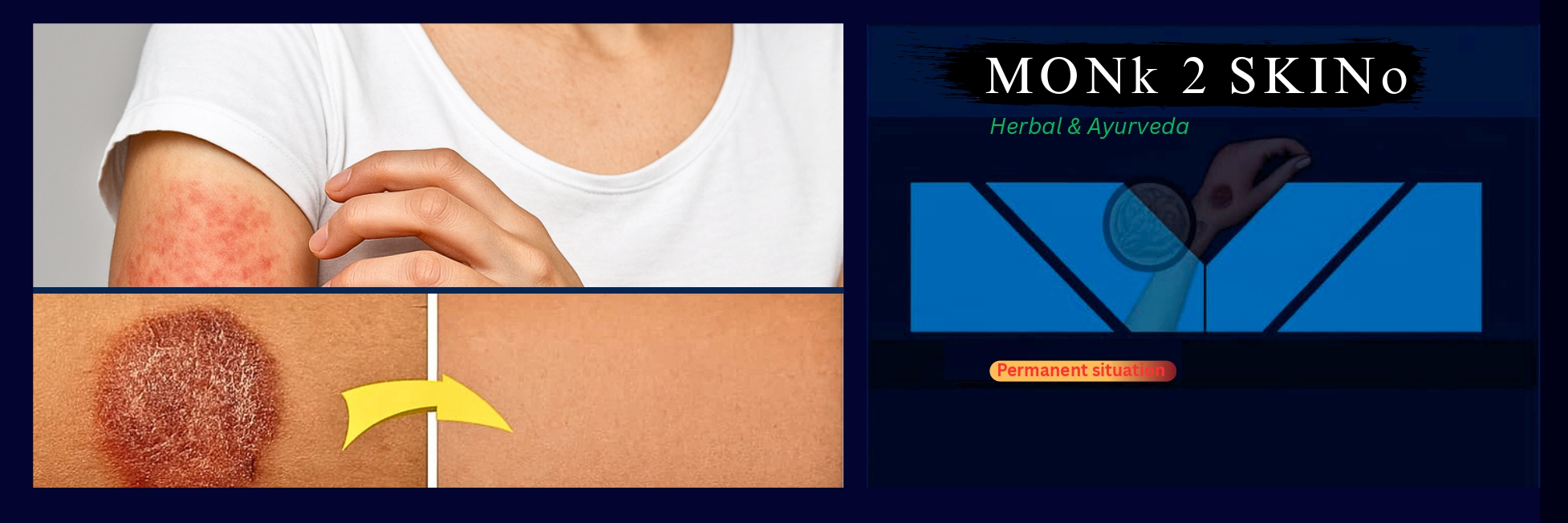 MONk 2 SKINo Ayurvedic Malham for Ringworm and Itching